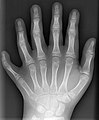 Eine moderne Aufnahme einer linken Hand mit 6 Fingern (Polydaktylie)