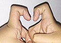 Unilateral extra phalangeal crease