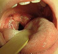 A set of large tonsils in the back of the throat covered in white exudate. A culture positive case of streptococcal pharyngitis with typical tonsillar exudate in an 8 year old.