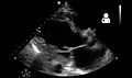 Ultrasound showing severe systolic heart failure[69]