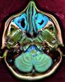Քրոնիկ սինուսիտի ՄՌՏ պատկեր 2 վերին ծնոտային ծոցերի լորձաթաղանթի այտուց և հաստացում։
