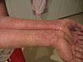 More severe dermatitis