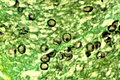Pneumocystis carinii (klassen Pneumocystidomycetes) er en gærlignende svamp, der forårsager lungebetændelse.