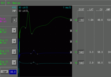 An example screenshot showing the results of a sensory nerve conduction velocity study