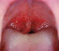 Mouth wide open showing the throat Note the petechiae, or small red spots, on the soft palate. This is an uncommon but highly specific finding in streptococcal pharyngitis.[10]