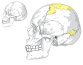 Además de los centros habituales de osificación de cráneo, otros pueden ocurrir, dando lugar a los huesos aislados irregulares denominados huesos suturales' o 'Wormianos. Esto ocurre con mayor frecuencia en el curso de la lambdoidal sutura, pero de vez en cuando se ve en la fontanelles, especialmente la posterior. Uno de ellos, el pterion ossicle, a veces existe entre el ángulo esfenoidal del hueso parietal y la gran ala del hueso esfenoides. Tienden a ser más o menos simétrica en los dos lados del cráneo, y varían de tamaño. Su número, es generalmente limitada a dos o tres, pero más de un centenar han sido encontradas en el cráneo de un adulto hydrocephalic. Por LadyofHats Mariana Ruiz Villarreal.