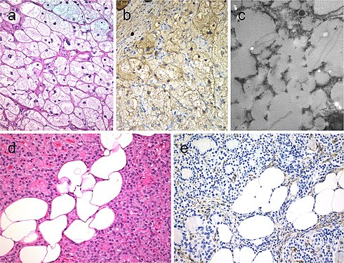 Lipid-rich follicular thyroid carcinoma (a) immunoreactive for thyroglobulin (b); the ultrastructural study evidenced numerous lipid vacuoles in the cytoplasm (ultrastructure) (c). Adenolipoma (lipoadenoma) in a patient with PTEN hamartoma tumor syndrome (d); there is negativity for PTEN protein in tumor cells while stromal cells (internal positive control) are positive (e)[7]
