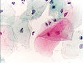 Normalne skvamozne ćelije u brisu
