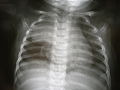 Na radiografia de tórax, o timo aparece como uma massa radiodensa (mais brilhante nesta imagem) pelo lobo superior do pulmão direito (esquerdo da imagem) da criança.