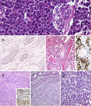 Carcinoma of the thyroid with Ewing family tumor elements (CEFTE) disclosing solid nests of small cells with regular, round nuclei, and nests of papillary thyroid carcinoma (PTC) (a). This case is from a 17-year-old female patient with bilateral involvement of the thyroid by a malignant thyroid teratoma (b); the tumor discloses nests of small cells, rich stroma with chondroid appearance and an epithelial-tubular component. Mixed medullary and papillary thyroid carcinoma (c); the medullary thyroid carcinoma component stained positively for calcitonin mRNA while the PTC (follicular variant) component was negative (d). Intrathyroid thymic carcinoma (ITC) also known by the acronym (CASTLE) showing positivity for CD5 (inset) (e). Spindle epithelial tumor with thymus-like differentiation (SETTLE) is a lobulated tumor composed of spindle cells and epithelioid cell component with glands, mucinous cysts, and/or squamous nests (f and g)[7]
