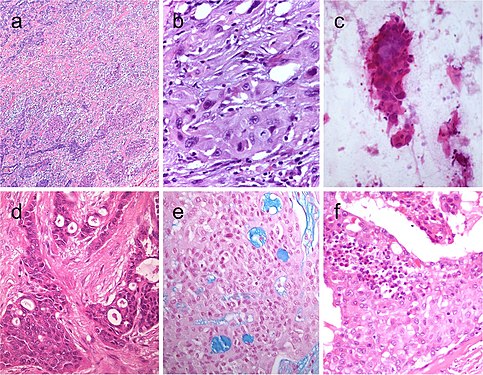 Squamous cell tumor examples that include extensive squamous metaplasia in PTC after fine needle aspiration biopsy (FNAB) (a), squamous cell carcinoma in the thyroid of putative secondary origin (b), and squamous cell carcinoma of the esophagus metastatic in the thyroid and diagnosed by FNAB (c). Mucoepidermoid carcinoma (d) composed by solid sheets of epithelial cells showing epidermoid cells and glandular spaces containing mucinous material positively stained with Alcian blue (e). Sclerosing mucoepidermoid carcinoma with eosinophilia showing epithelial cells richly infiltrated by eosinophils, lymphocytes, and plasma cells (f)[7]