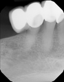 This radiograph of a "bridge" dental restoration features a cantilevered crown to the left.